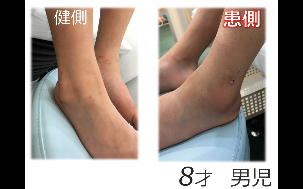 右足外果骨折装具 右足外果骨折装具