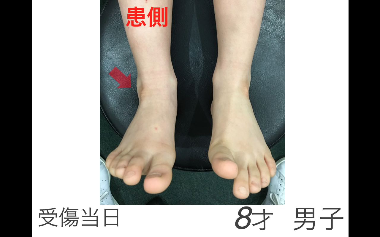 こどもの足のねんざは剥離骨折に注意が必要です - やまもと接骨院 | 岐阜県笠松町・岐南町のほねつぎ・接骨院